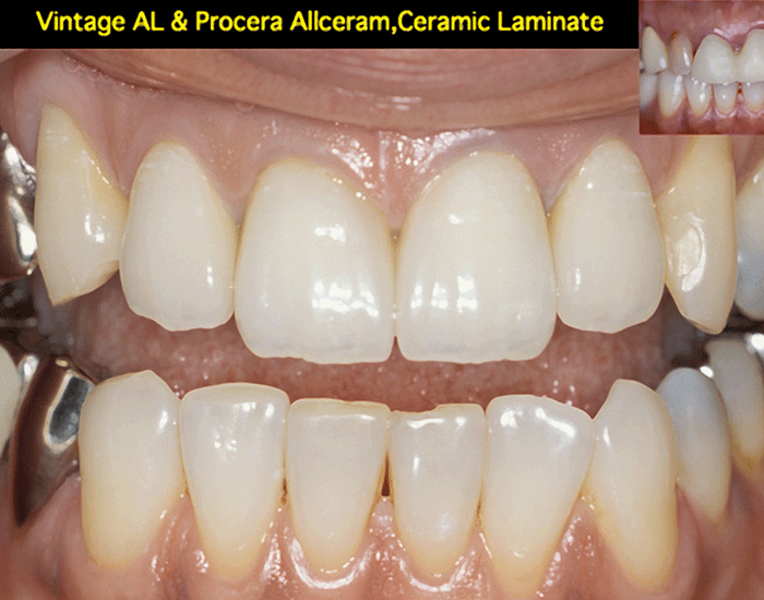 図２５ 上顎　両中切歯：Vintage AL、両側切歯：セラミックラミネートベニヤ、右側犬歯：メタルセラミック