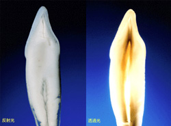 天然歯のオパール効果-05.jpg